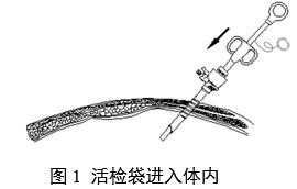 一次性使用內(nèi)窺鏡用活檢袋注冊審查指導原則（2025年第20號）(圖1)